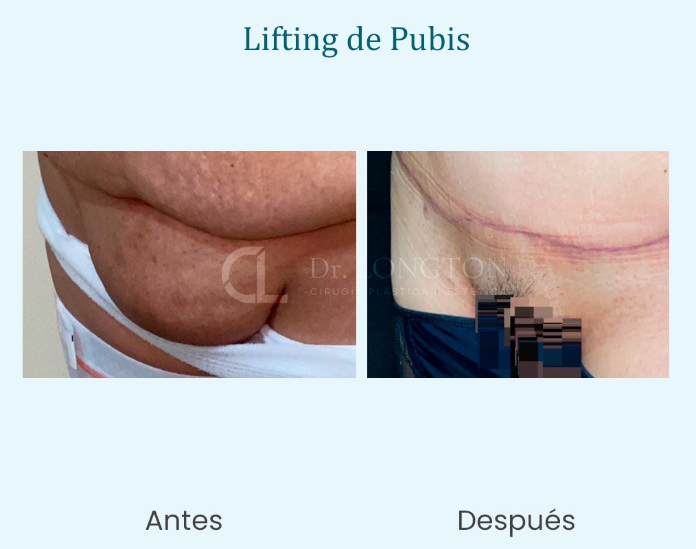 lifting de pubis femenino antes y después