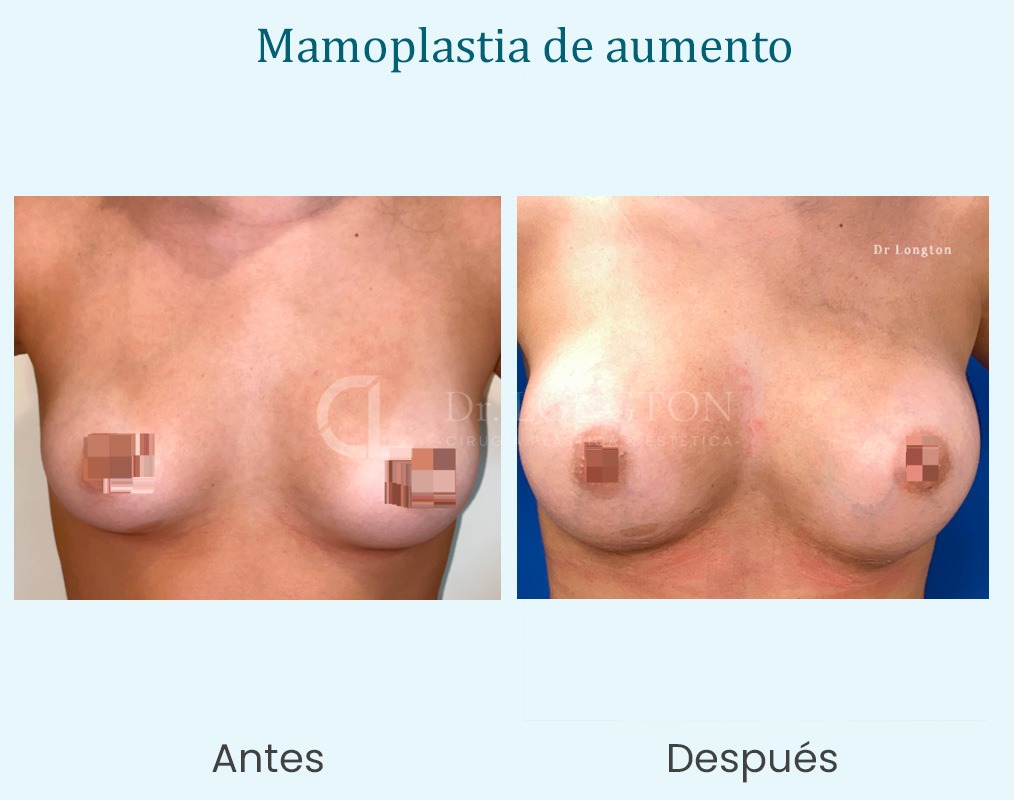 mamoplastia de aumento cirugía en santiago