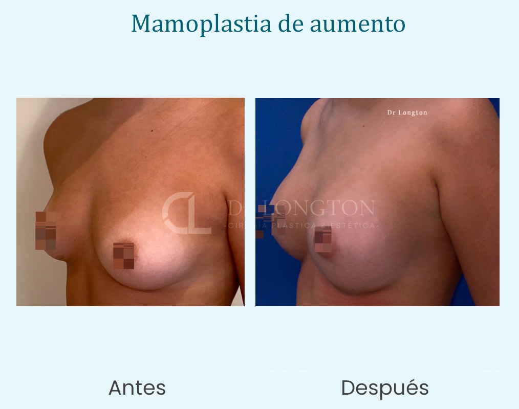 mamoplastia de aumento cirugía de mamas caso