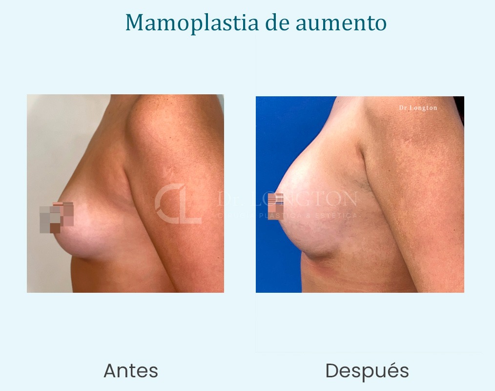 mamoplastia de aumento caso de exito cirugia