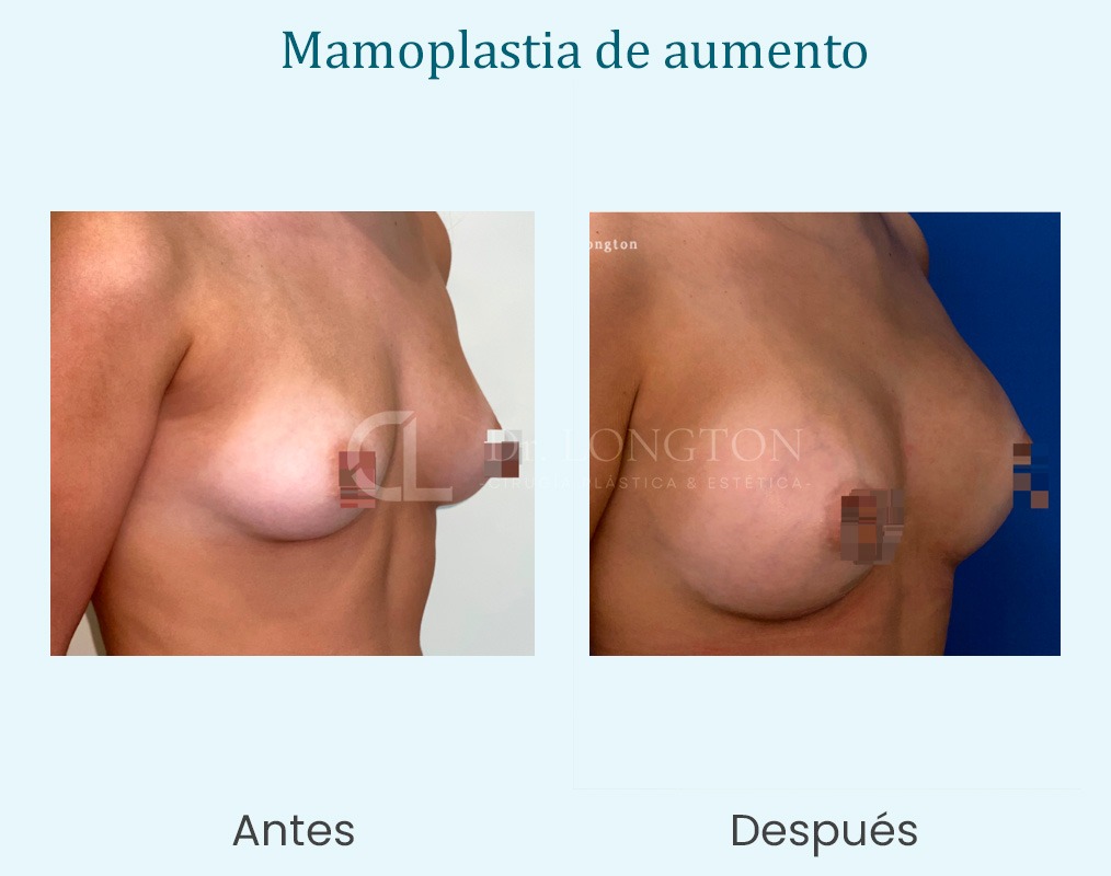 mamoplastia de aumento a y d caso