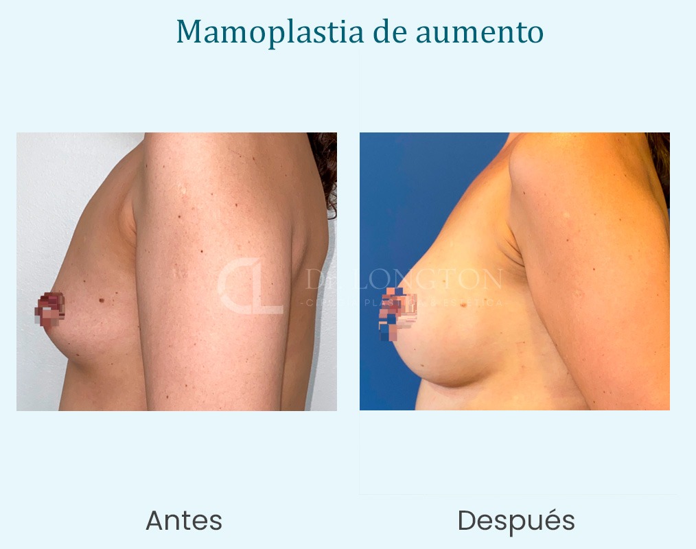 mamoplastia de aumento cirugia caso