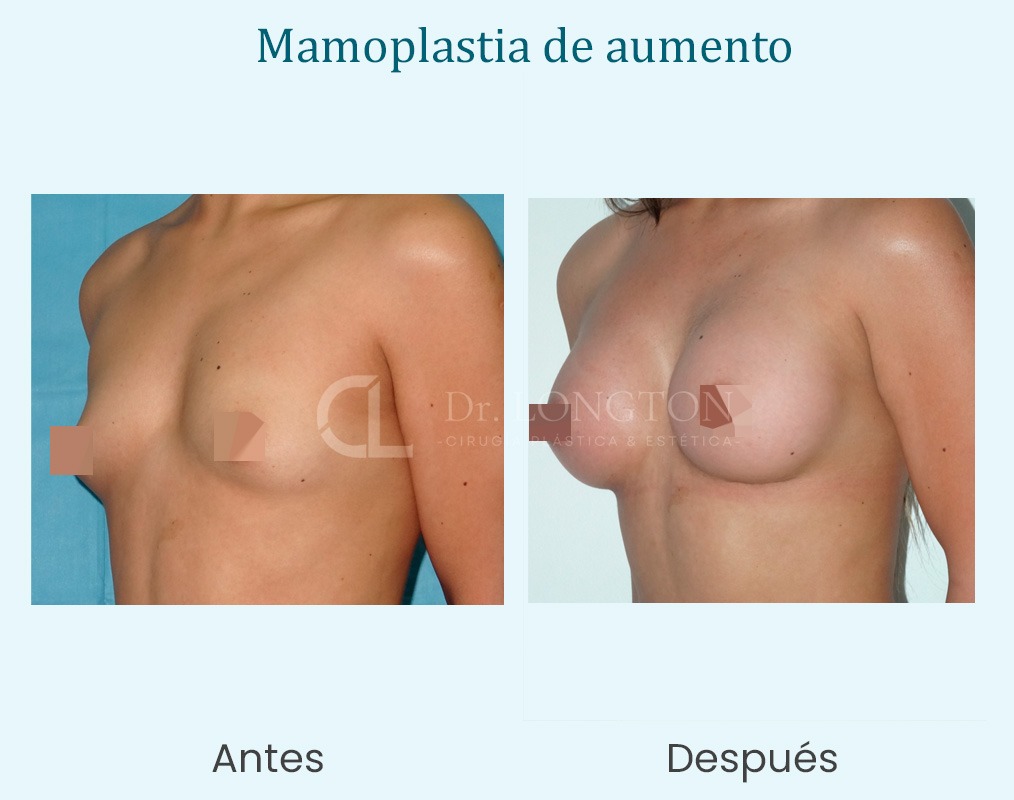 mamoplastia de aumento antes y después caso