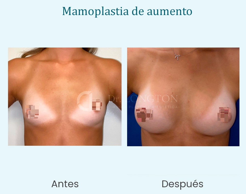 mamoplastia de aumento