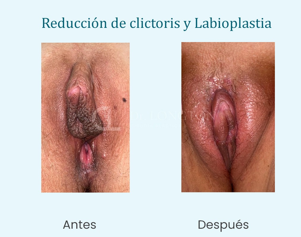 cirugia reduccion de clitoris y labioplastia