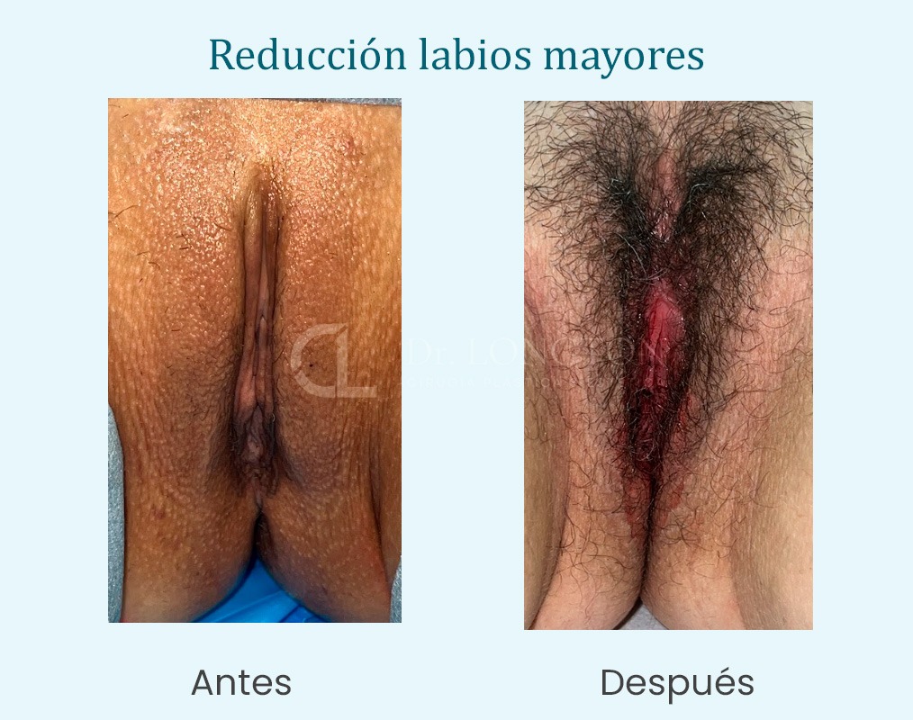 reducción labios mayores antes y despues caso