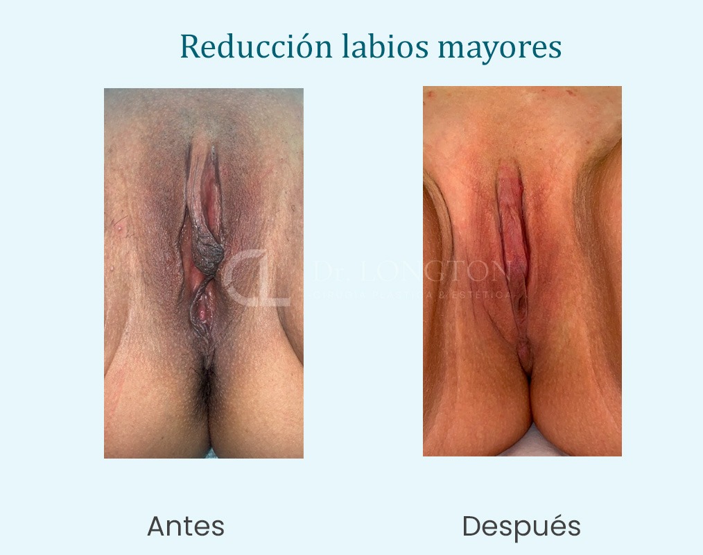 reducción de labios mayores antes y despues