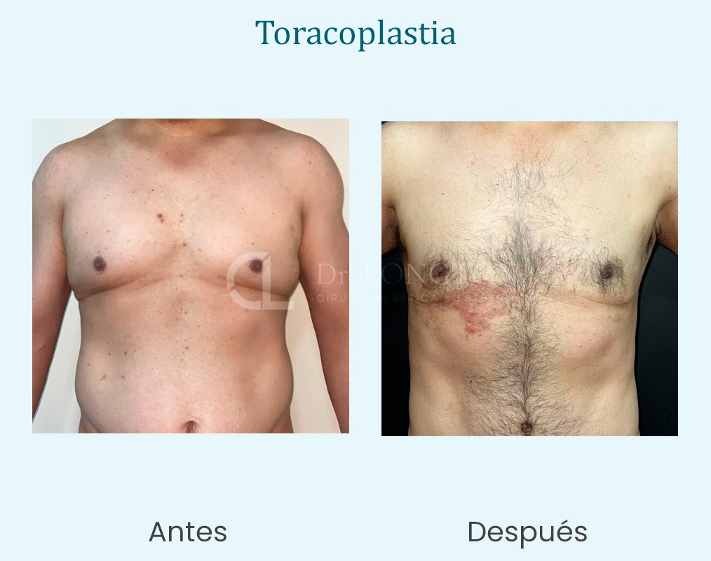 taracoplastia antes y después