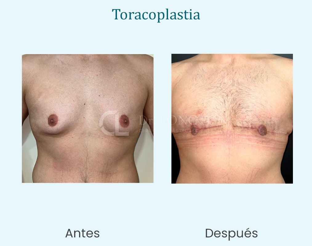 taracoplastia caso