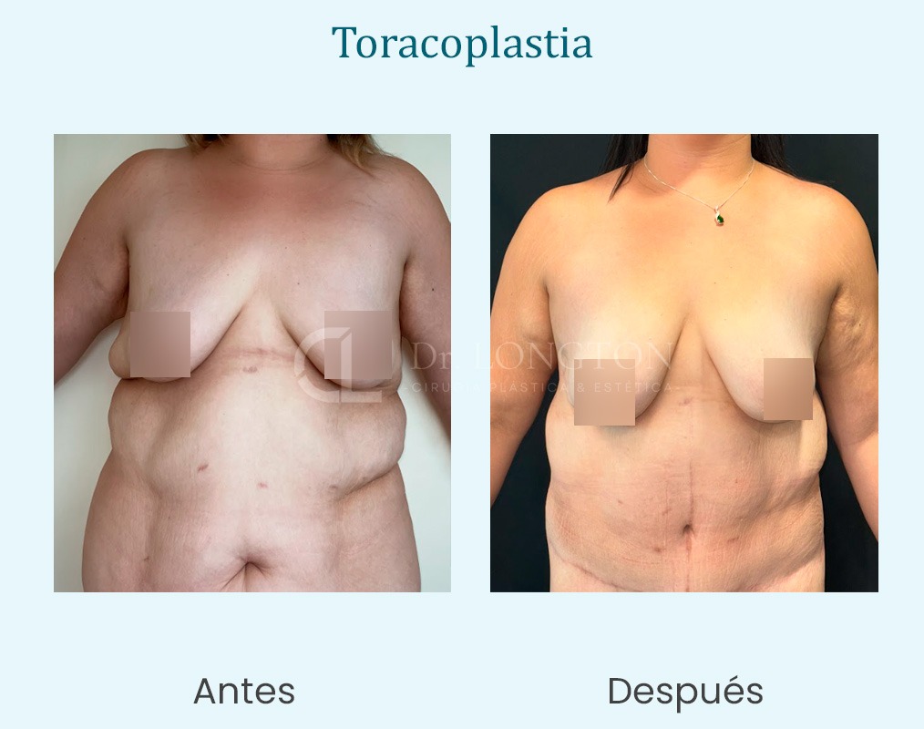 cirugpia taracoplastia caso