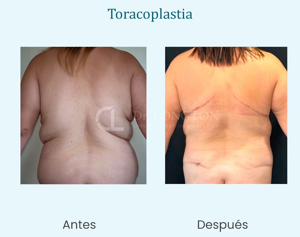 taracoplastia cirugía