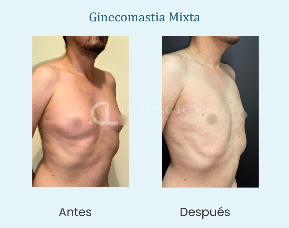 Ginecomastia Mixta