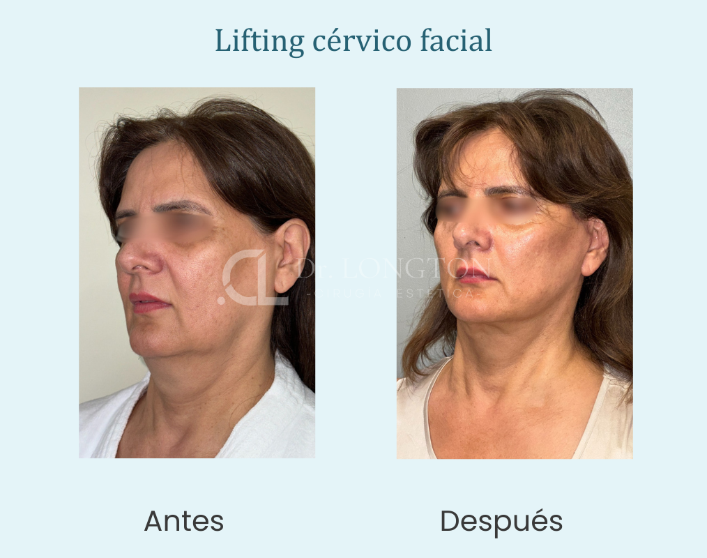 Lifting cervico facial