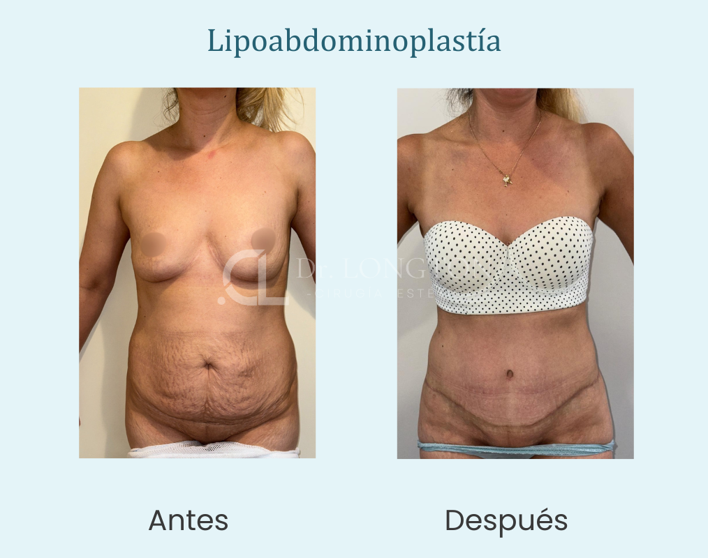 Lipoabdominoplastia