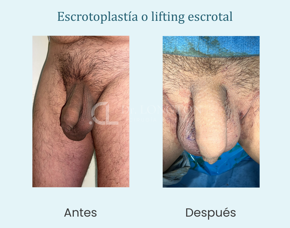 escrotoplastía o lifting escrotal