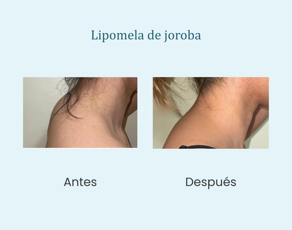 lipomela de joroba