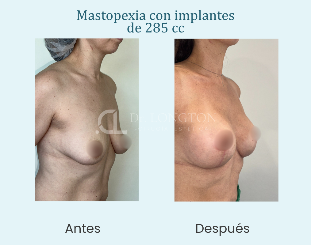 mastopexia con implantes de 285 cc