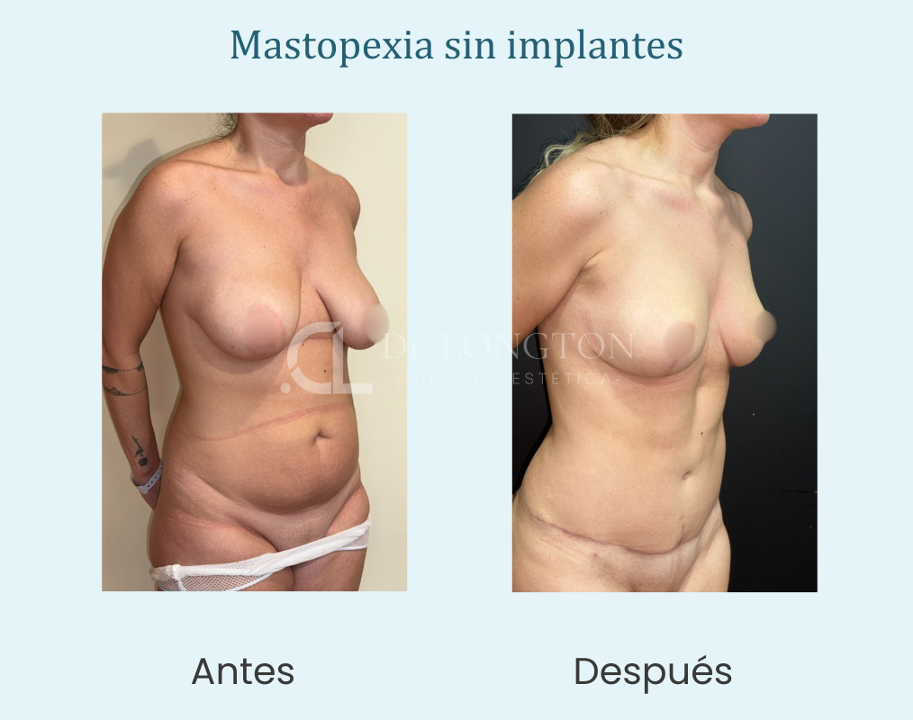 mastopexia sin implantes
