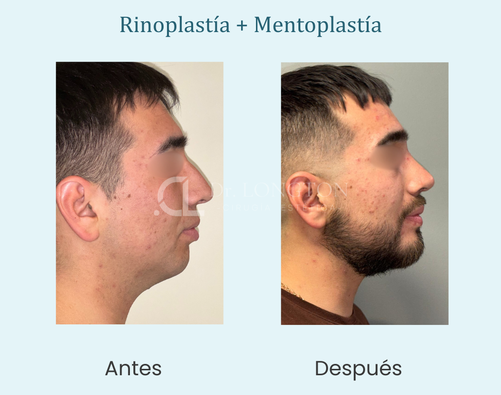 rinoplastía y mentoplastía