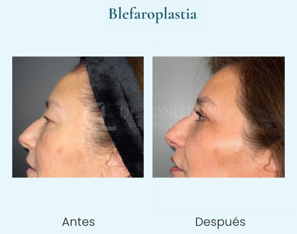 blefaroplastia1