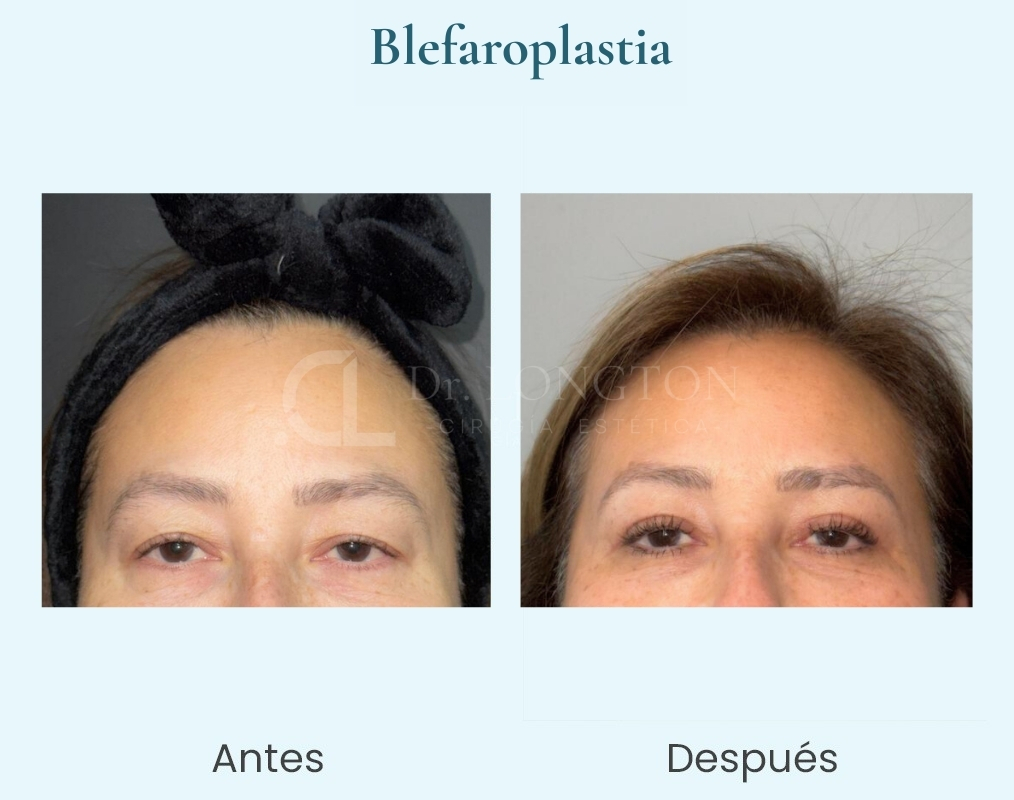 blefaroplastia2
