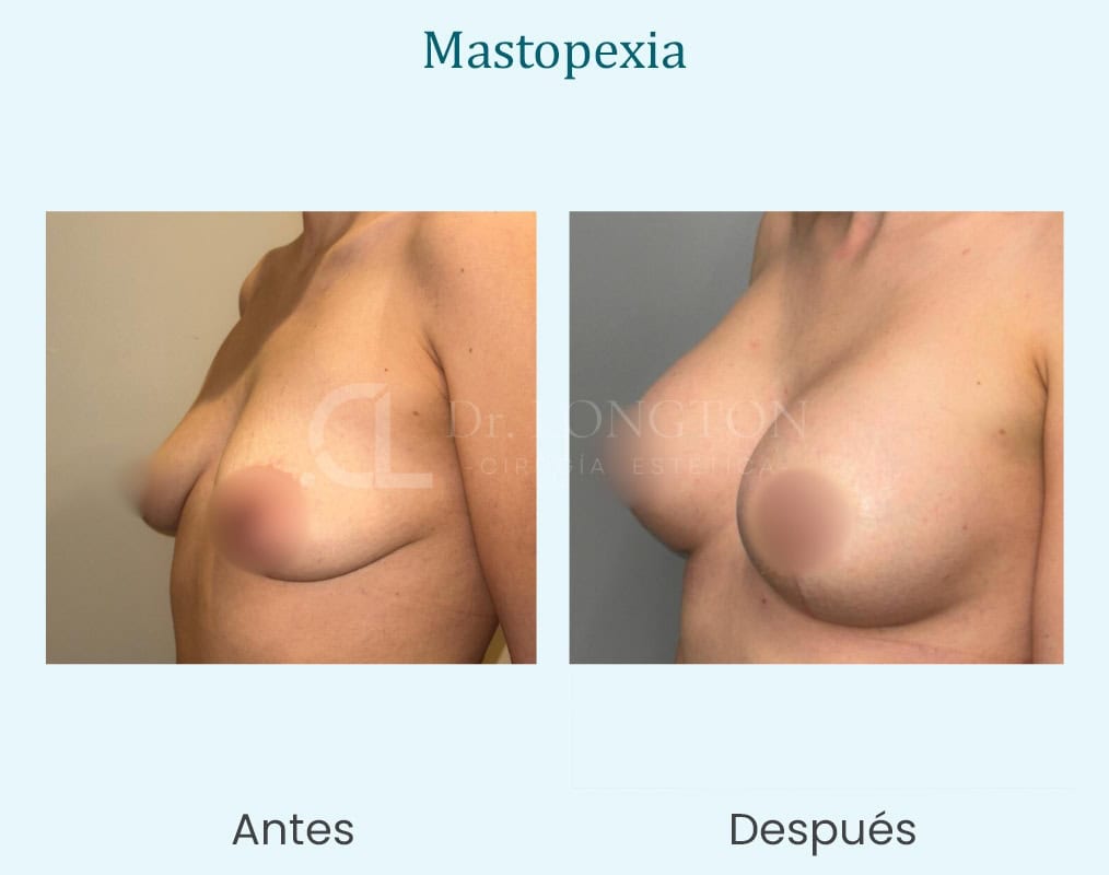 mastopexia