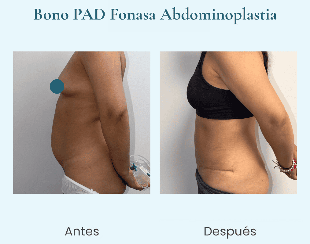 abdominoplastia bono pad