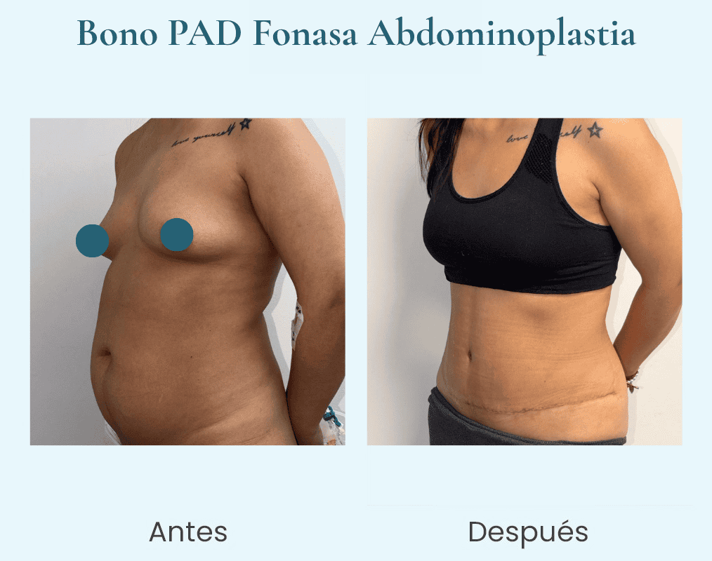 abdominoplastia bono pad