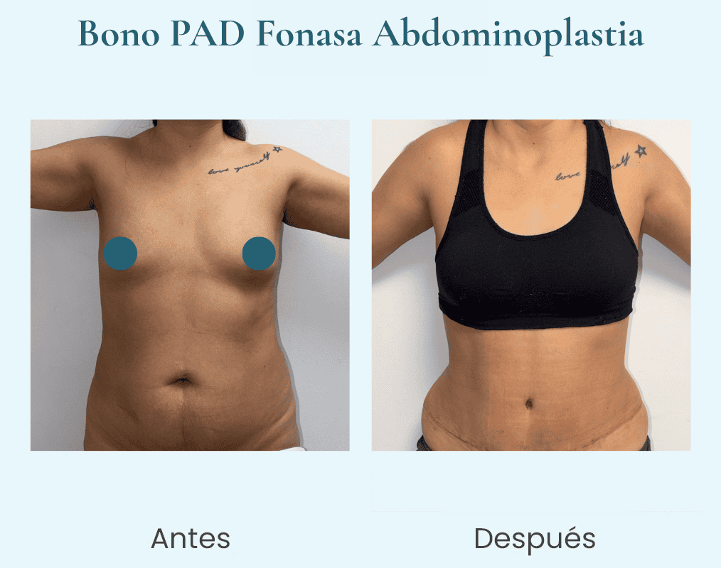 abdominoplastia bonopad