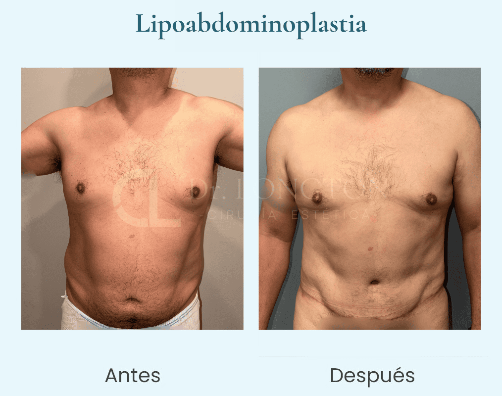Lipoabdominoplastia hombre perfil a y d