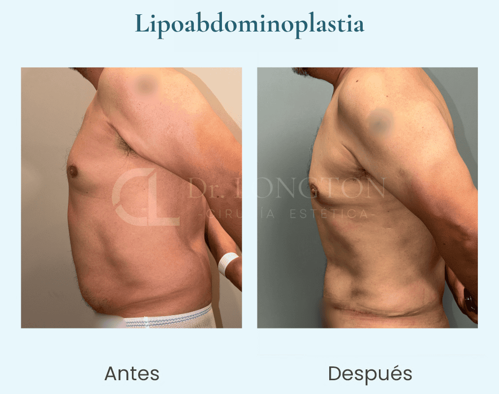 Lipoabdominoplastia hombre perfil