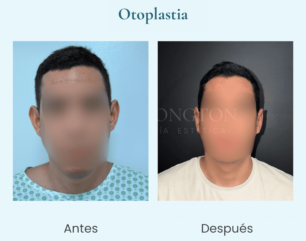 otoplastia-dr-longton-chile