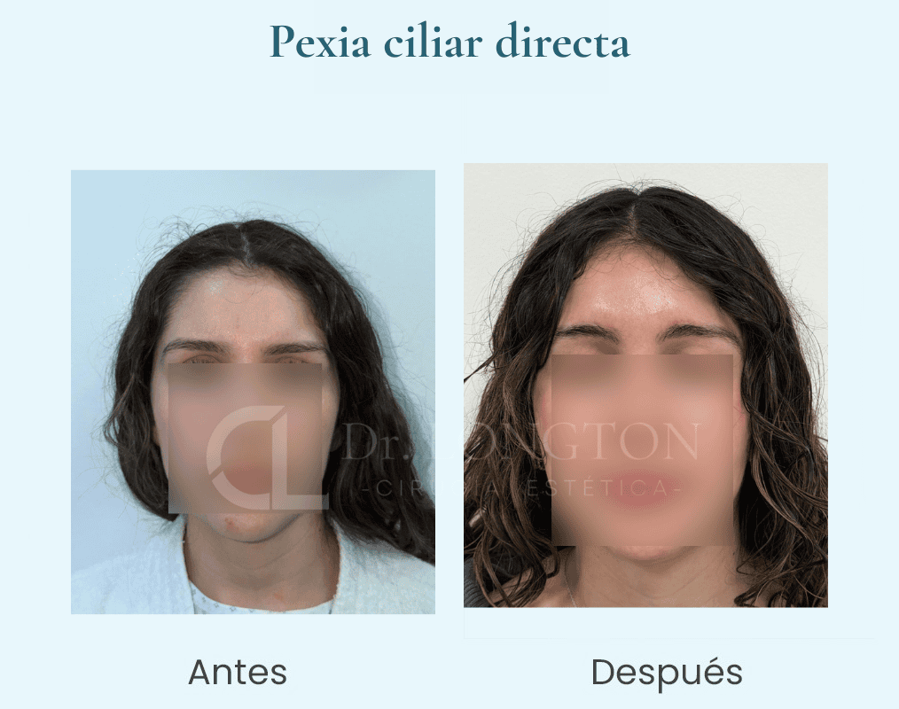 pexia-ciliar-directa-dr-longton-chile