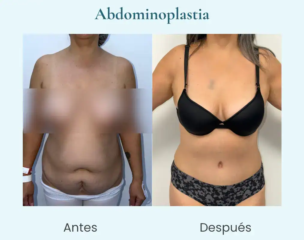abdominoplastia caso-a