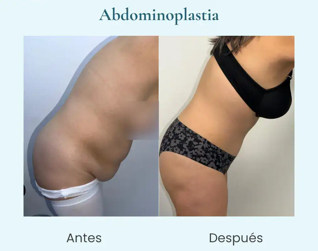 abdominoplastia casoa-2