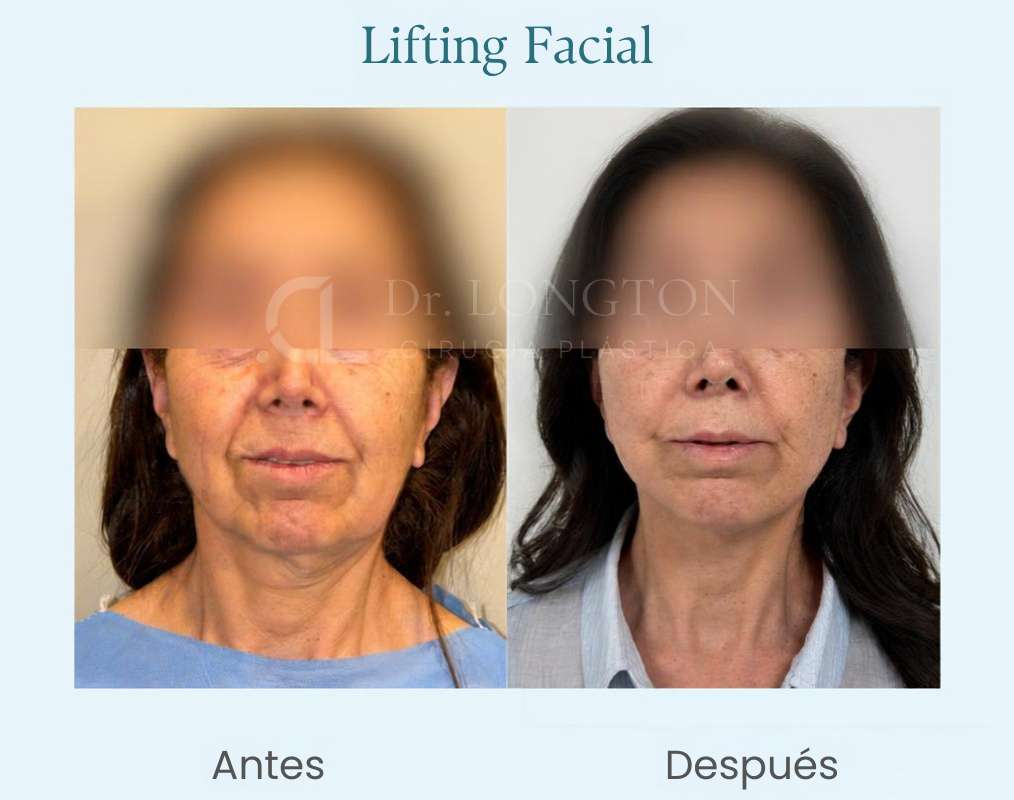 lifting facial antes y despues