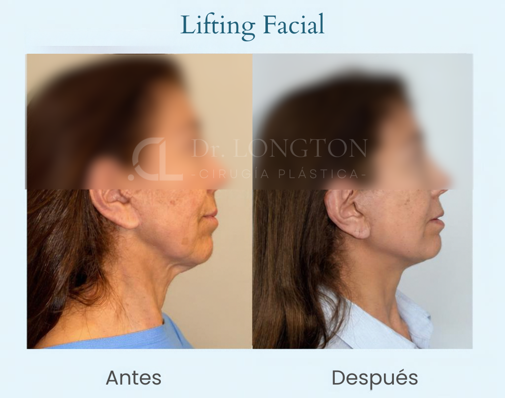 lifting facial antes y despues