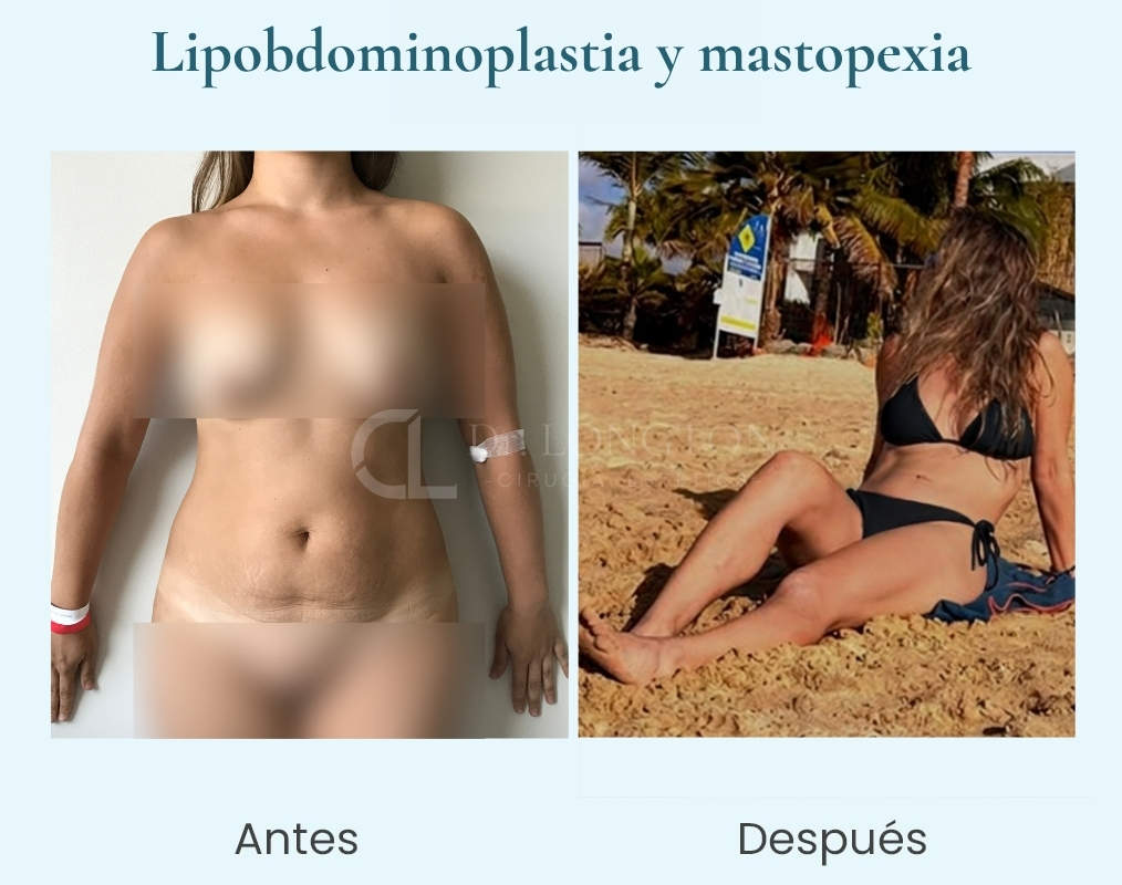 lipoabdominoplastia y mastopexia dr longton