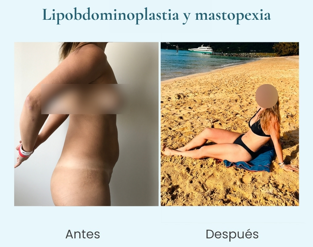 lipoabdominoplastia y mastopexia dr longton