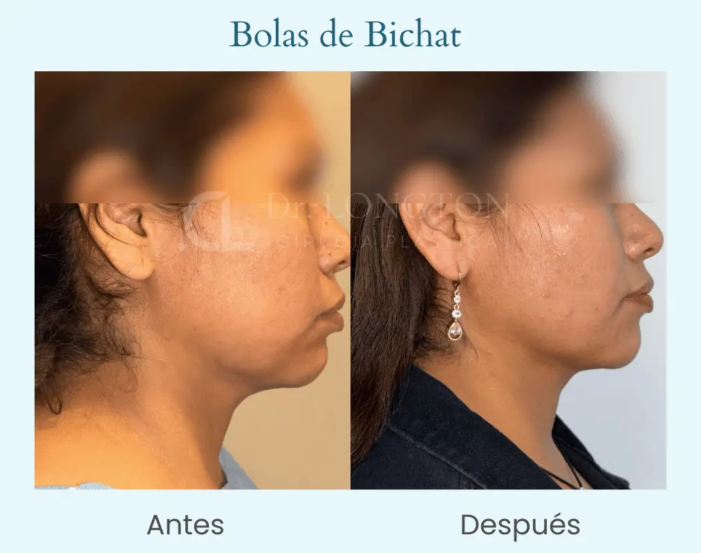 Bolas de bichat 2