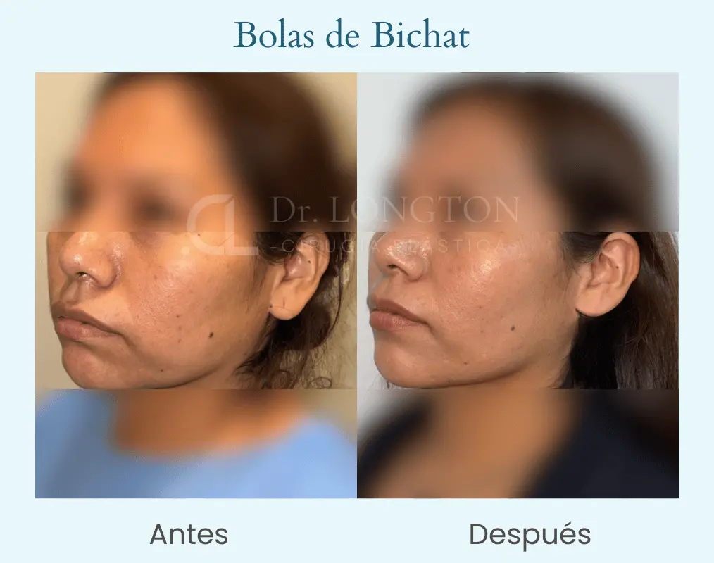 Bolas de bichat 3