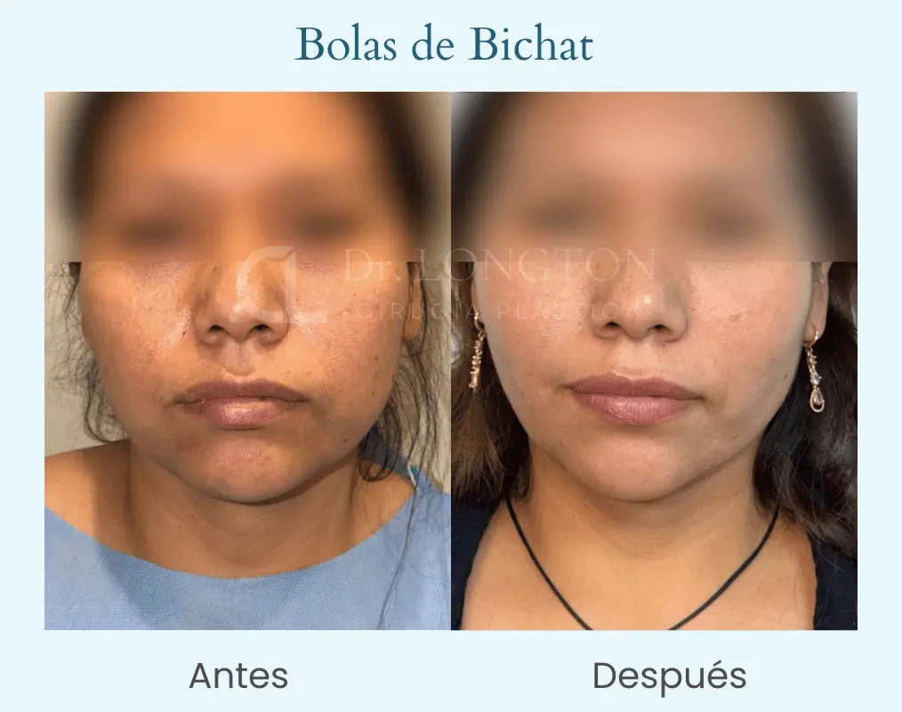 Bolas de bichat