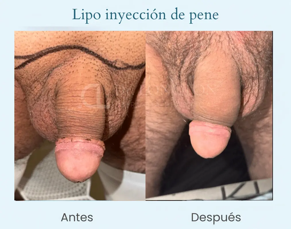 Lipoiyección de pene (2)