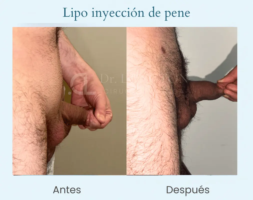 Lipoiyección de pene (3)