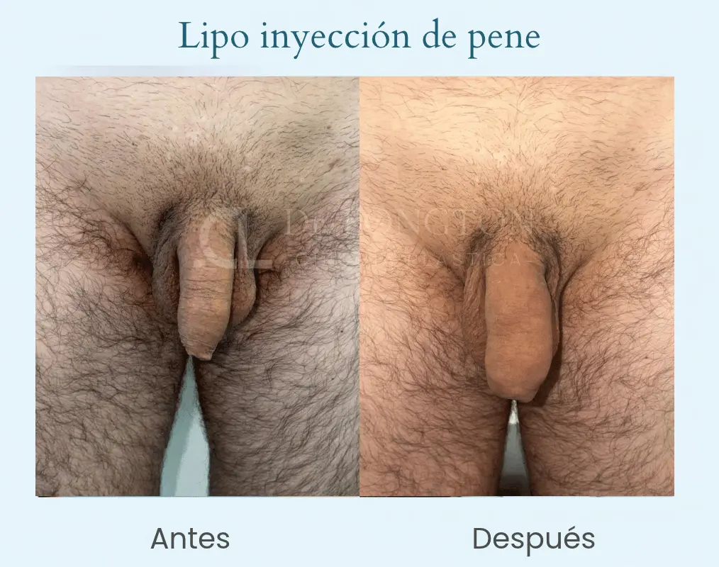 Lipoiyección de pene