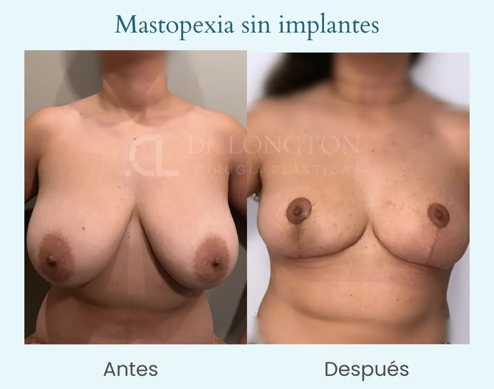 Masopexia sin implantes 2