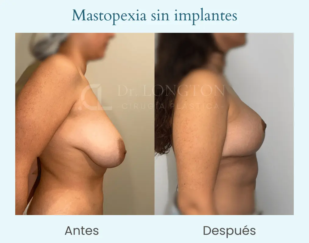 Masopexia sin implantes